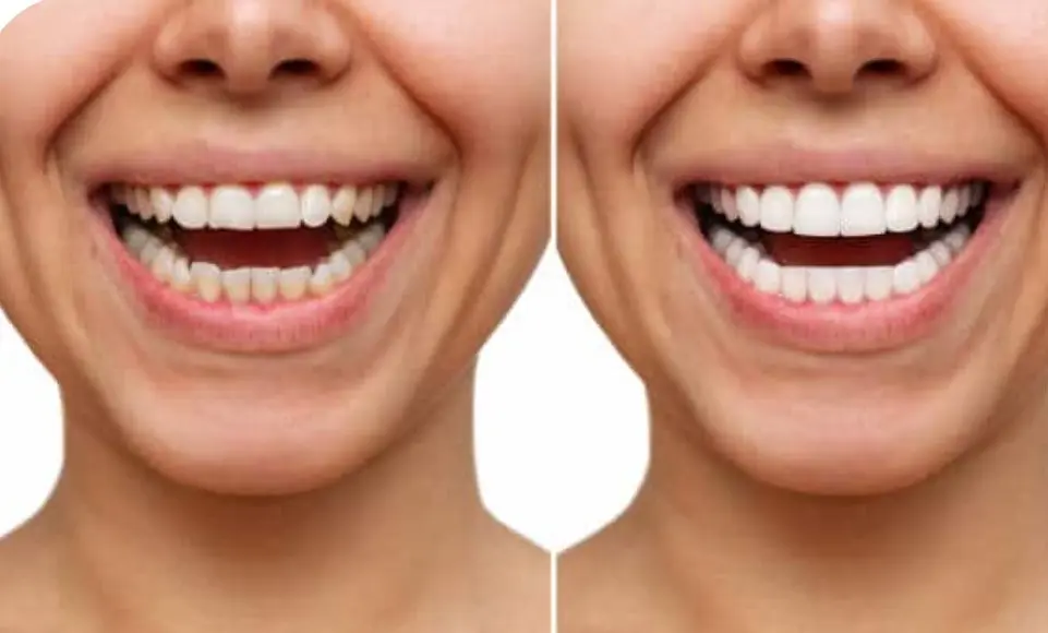 Porcelain vs. Composite Veneers Which Option is Best for Your Smile