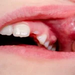 Why You Can't Open Your Mouth Properly When a Tooth Is Infected